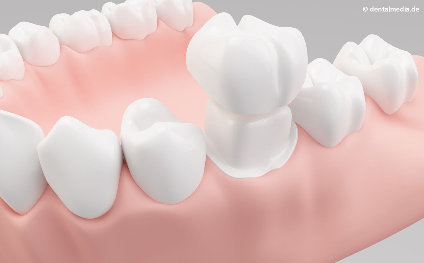 Vollkeramische Kronen  : Metallfreie Krone - komplett bestehend aus Hochleistungskeramik